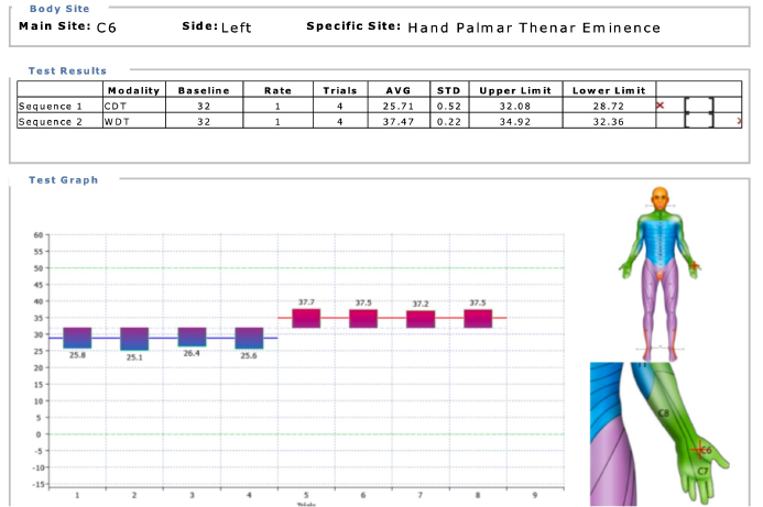 QST Assessment report showing sensory testing in an individual with abnormal SFN function as recorded using an non-invasive asse